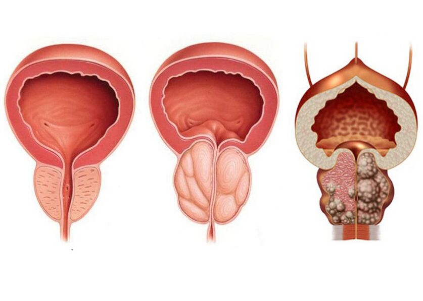 Etapas da prostatite e a necesidade de usar plenamente a prostavit